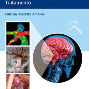 Aneurismas Cerebrais
