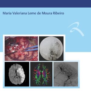 Doença Cerebrovascular na Infância e Adolescência