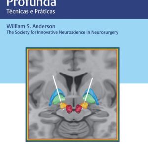 Estimulação Cerebral Profunda